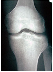 膝関節　膝　治療　整体　八王子　多摩　みなみ野　サンスマイルのレントゲン