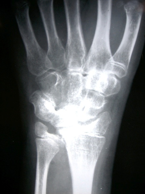 東京・八王子駅前の酸素カプセル：サンスマイル八王子の骨折レントゲン