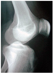 八王子　日野　多摩　八王子みなみ野　膝関節　膝　痛み　治療　サンスマイル八王子