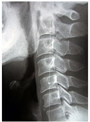 頚椎　首　治療　ストレートネック　整体　カイロプラクティック　八王子　日野　多摩　相模原