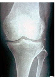 膝関節症　八王子　日野　多摩　八王子みなみ野　サンスマイル八王子　痛み　膝　治療