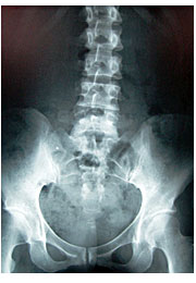 東京・多摩地区のカイロプラクティック・整体院：サンスマイルのレントゲン：キャビンアテンダント・客室乗務員・ＣＡの歪み解消